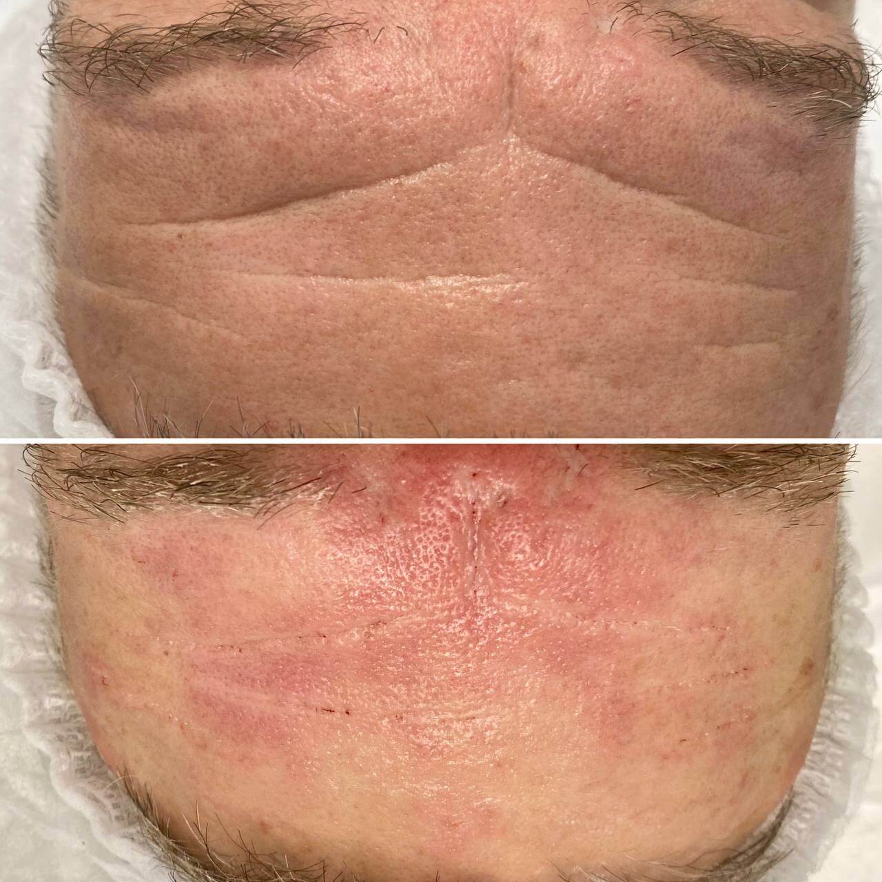 Контурная пластика лица 01