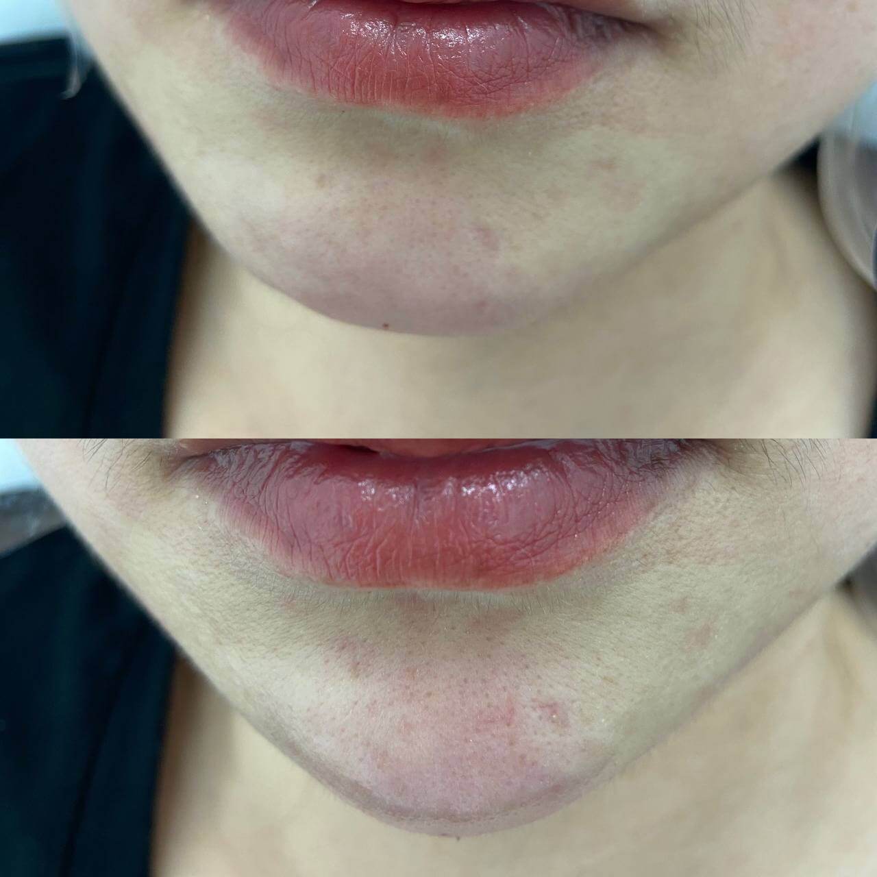 Контурная пластика лица 01