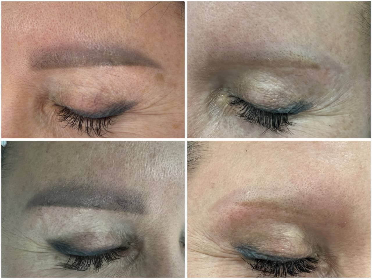 Удаление татуажа PicoSure 01