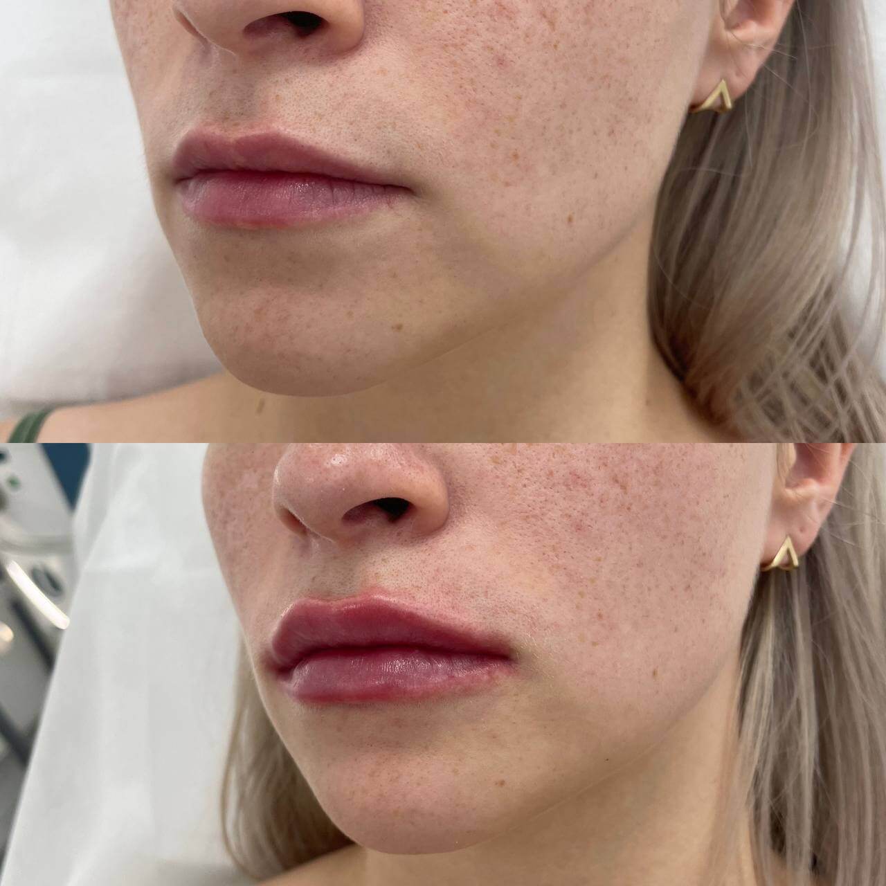 Увеличение губ 01