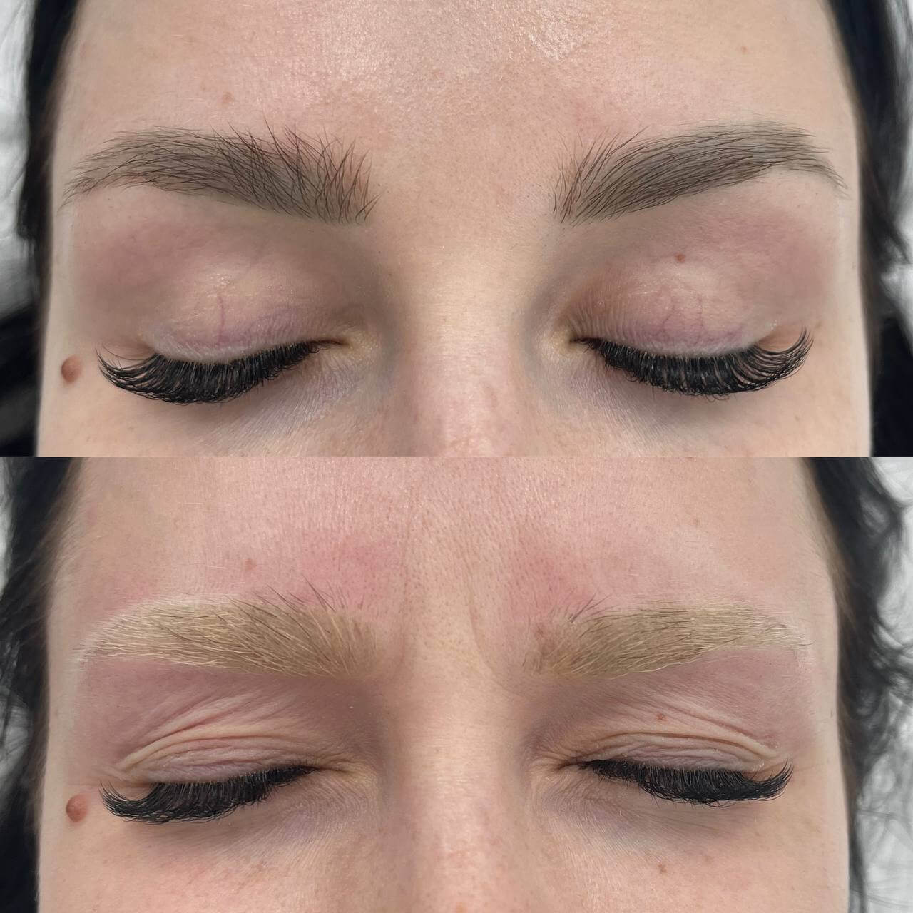 Удаление татуажа PicoSure 01