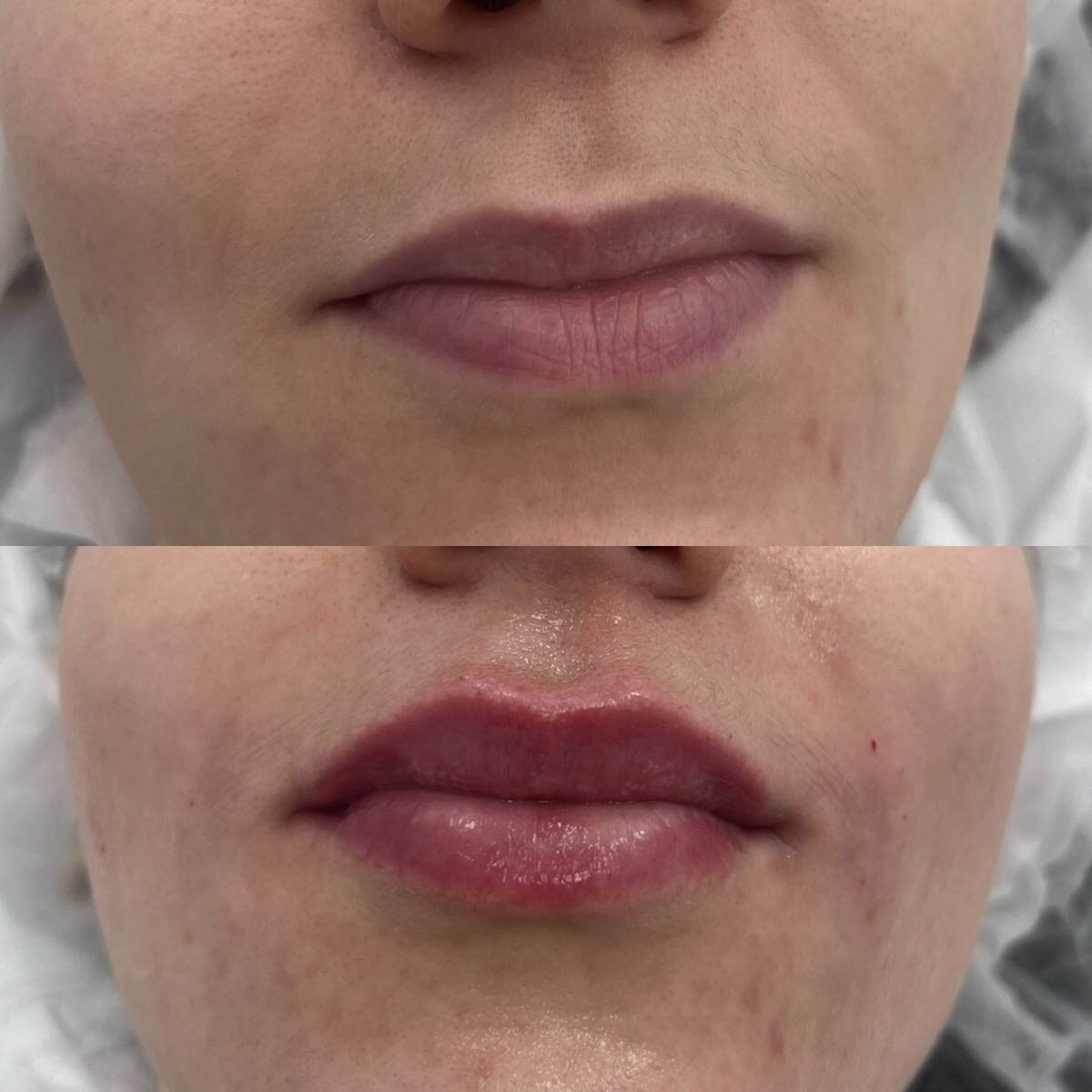 Увеличение губ 01