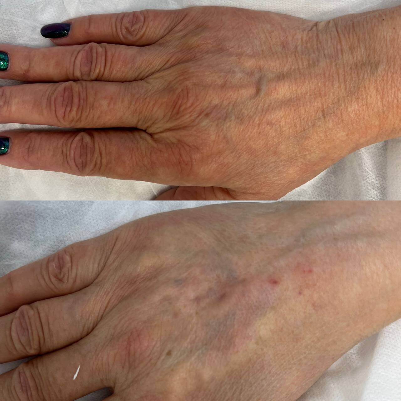 Филлер Радиесс (Radiesse) 01