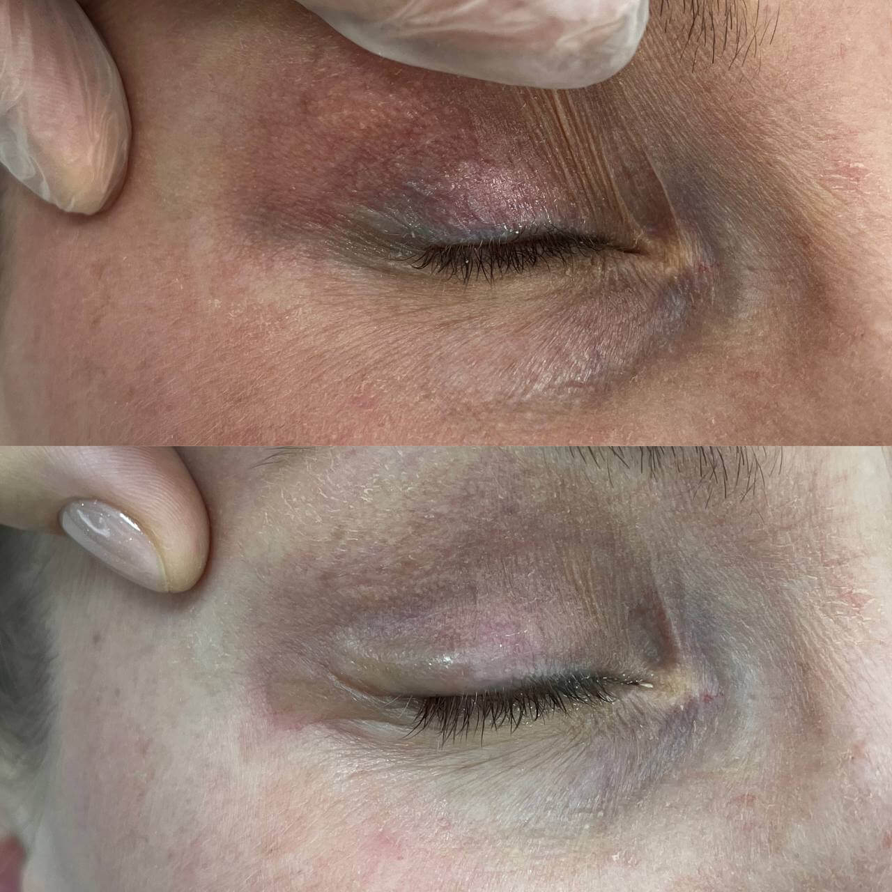 Удаление татуажа PicoSure 01