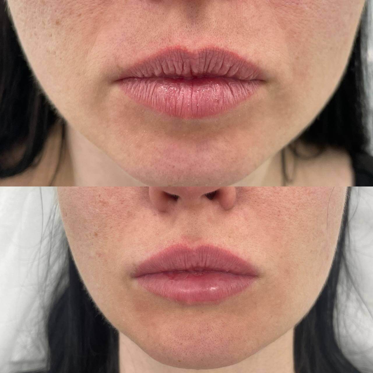 Увеличение губ 01