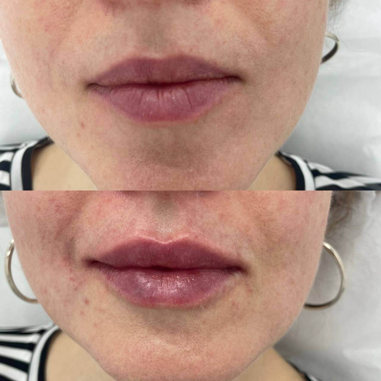 Увеличение губ 01