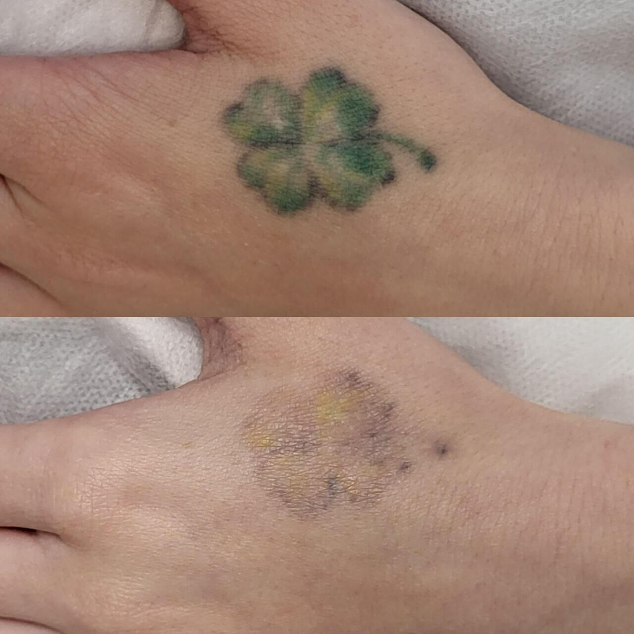 Удаление татуировок PicoSure 01