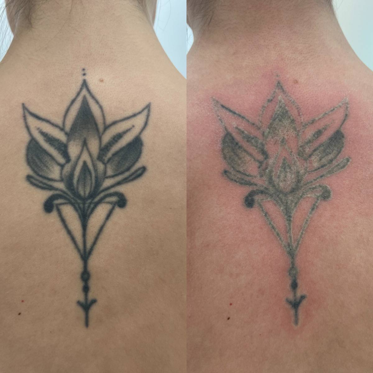 Удаление татуировок PicoSure 01