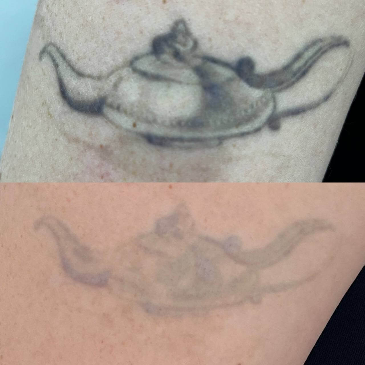 Удаление татуировок PicoSure 01