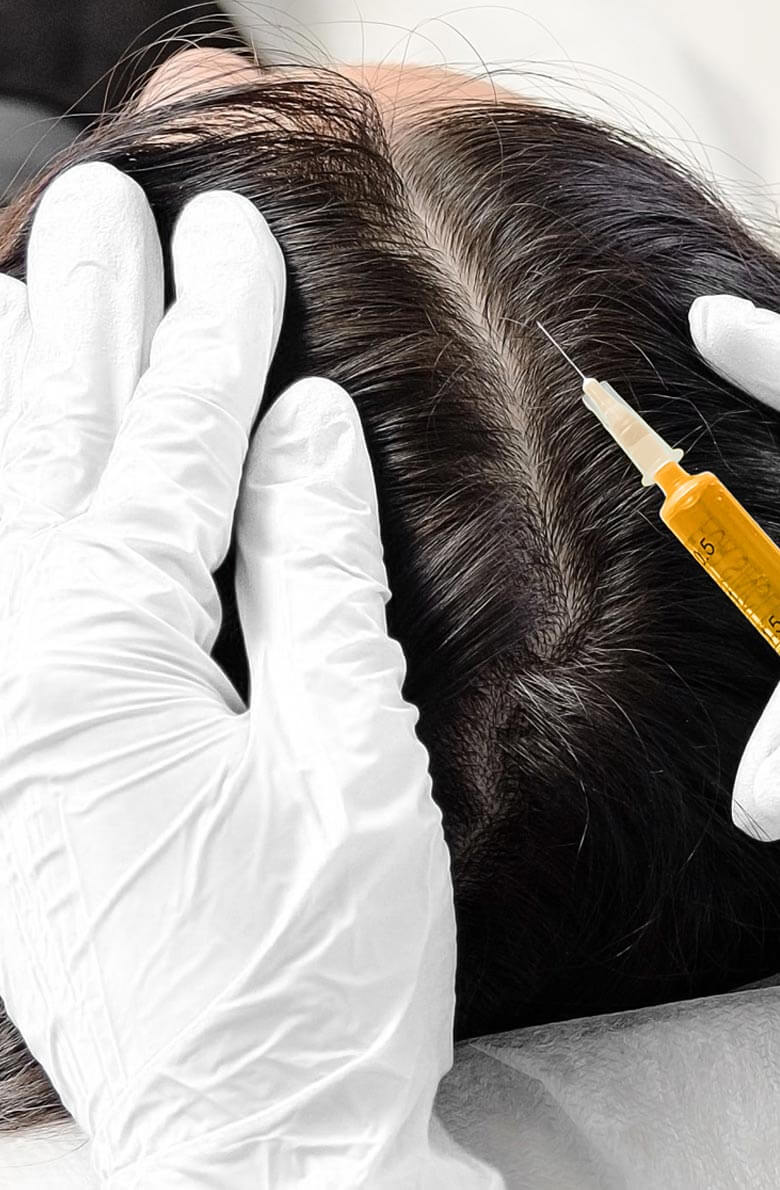 Плазмолифтинг (плазмотерапия)