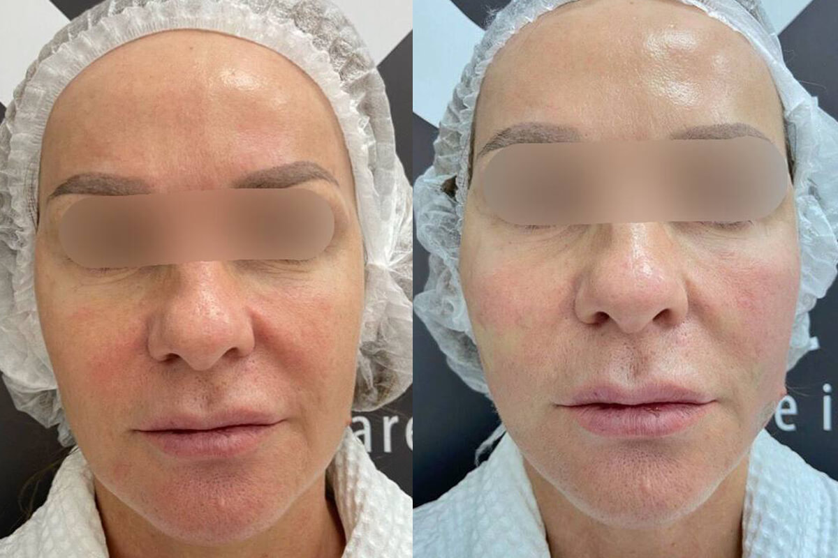 Филлер Радиесс (Radiesse) 01