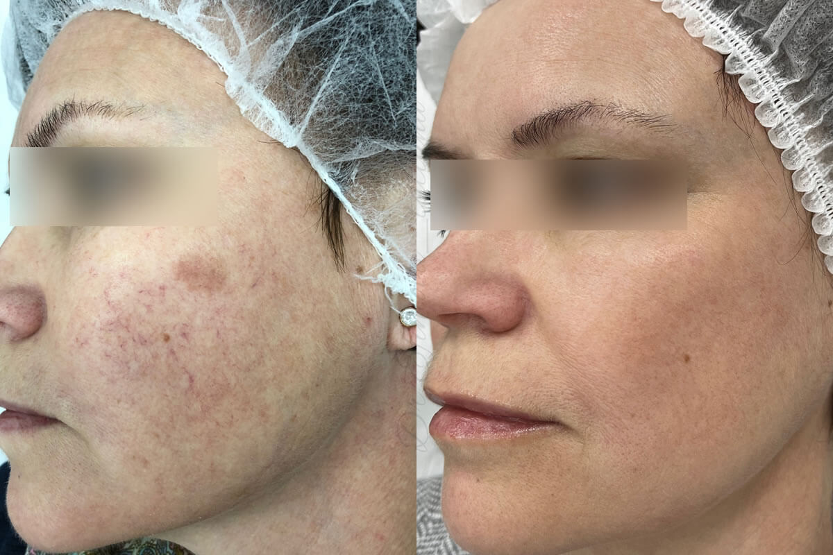 Удаление пигментных пятен 01