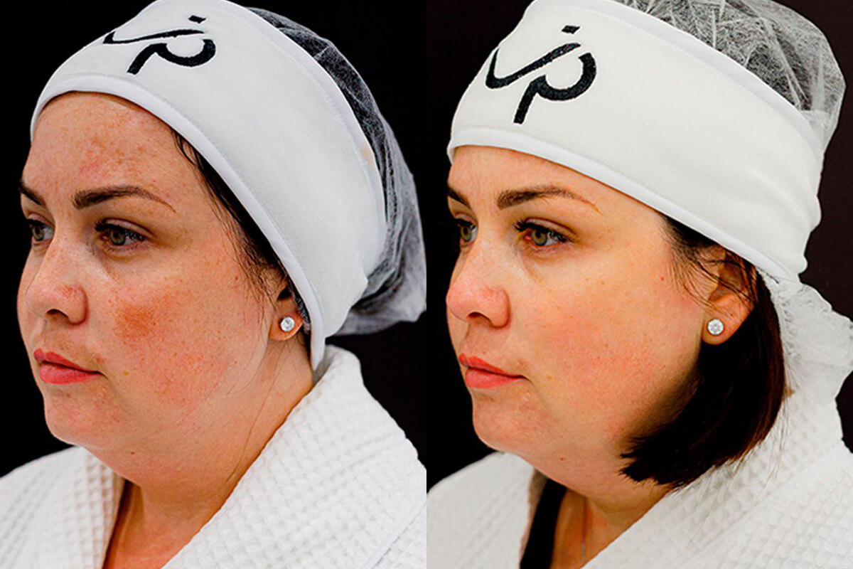 Лазерное омоложение лица PicoSure 01