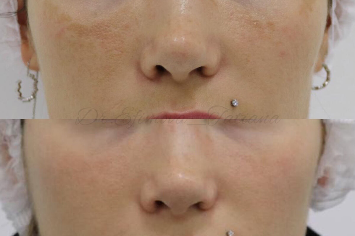 Удаление пигментации PicoSure 01