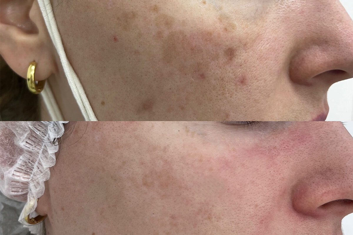 Удаление пигментных пятен 01