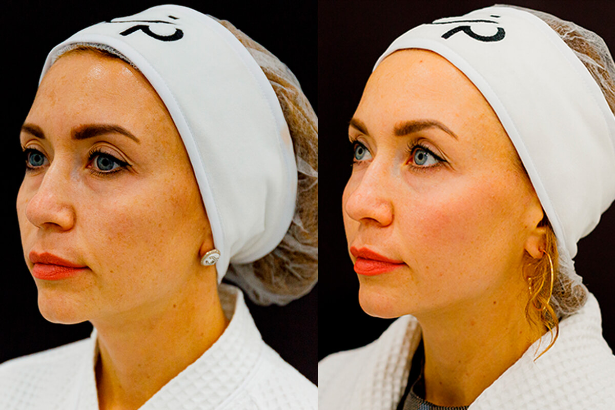 Удаление пигментации PicoSure 01