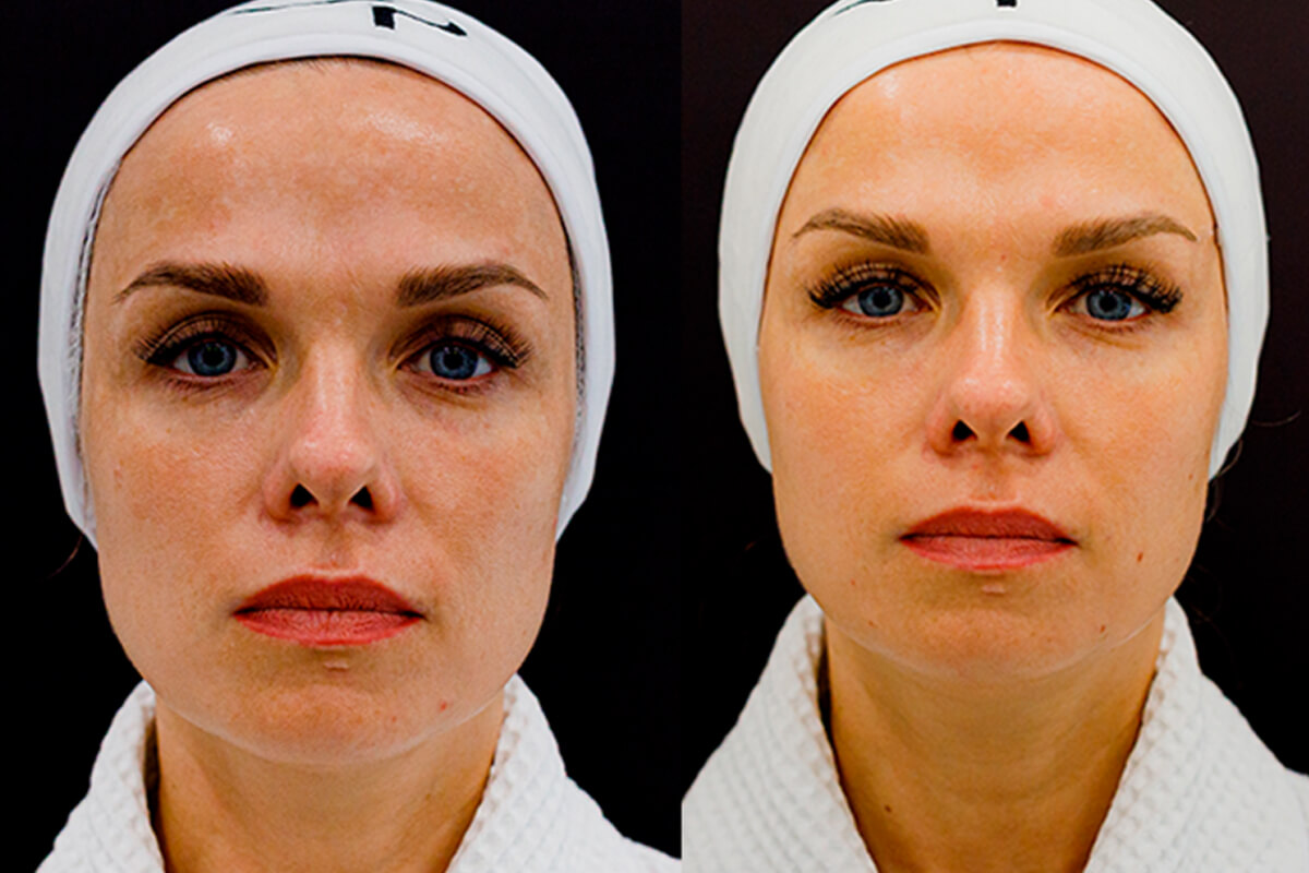 Удаление пигментации PicoSure 01