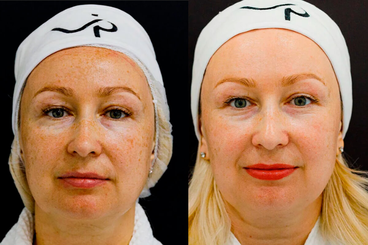 Лазерное омоложение лица PicoSure 01