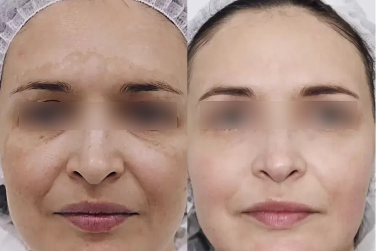 Лазерное омоложение лица PicoSure 01