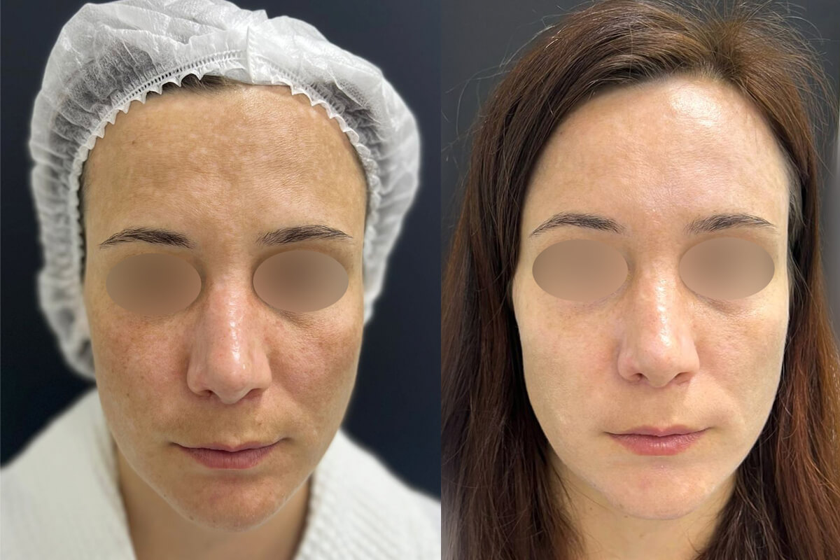 Удаление пигментации PicoSure 01