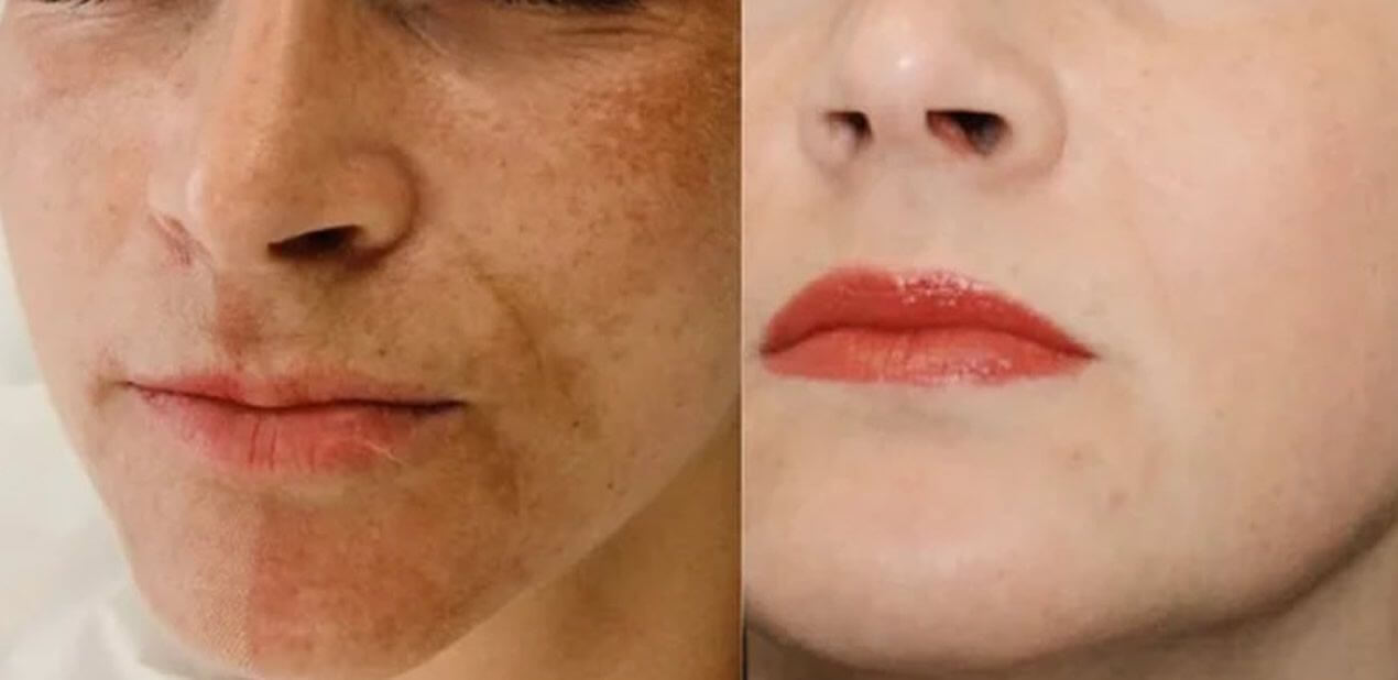 Удаление пигментации PicoSure 01