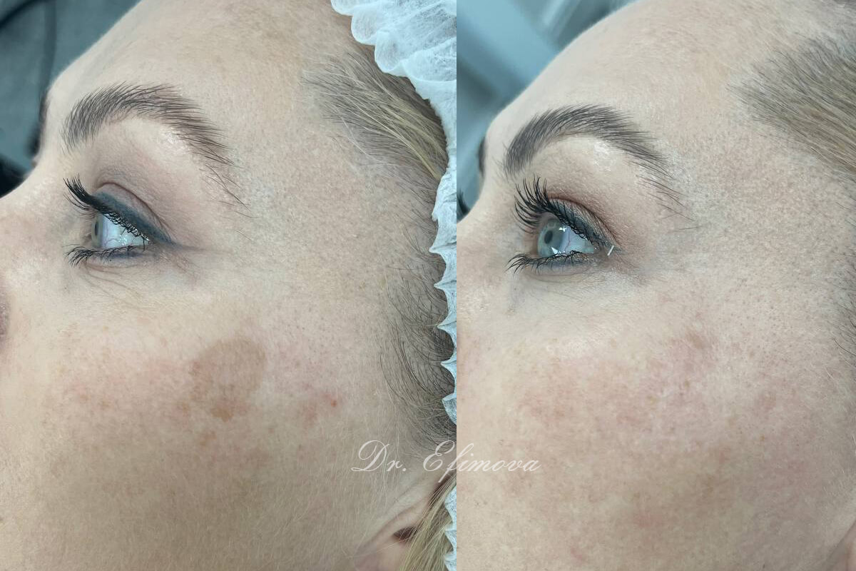 Удаление пигментных пятен 01