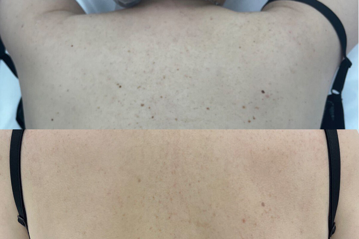 Удаление пигментации PicoSure 01