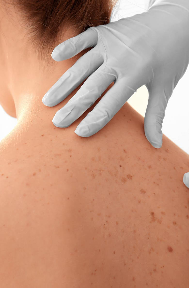 Удаление пигментных пятен