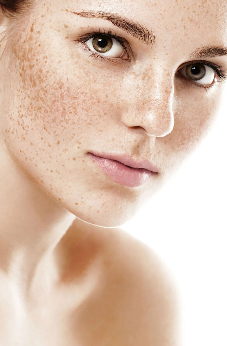 udalenie-pigmentnykh-pyaten-2