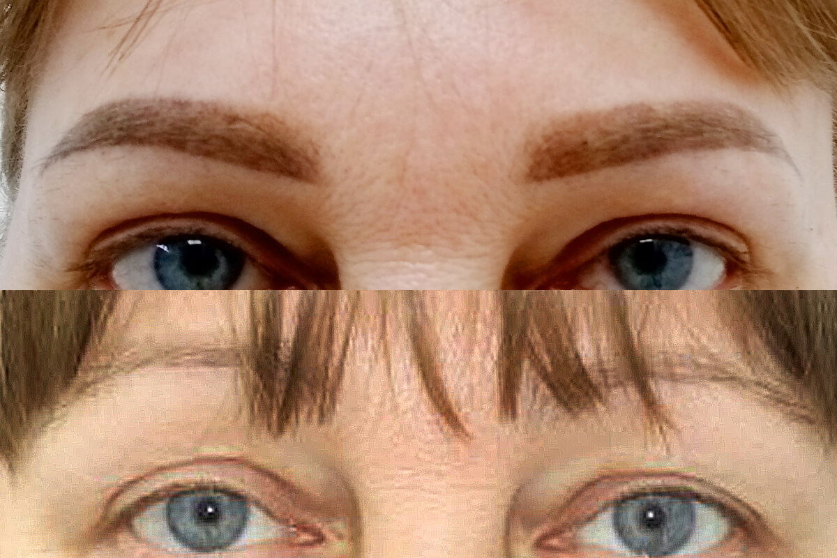 Удаление татуажа PicoSure 01