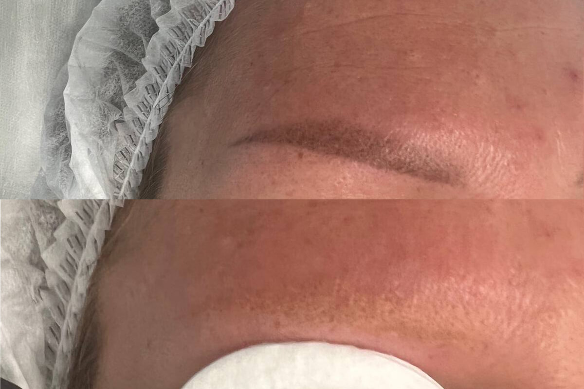 Удаление татуажа PicoSure 01