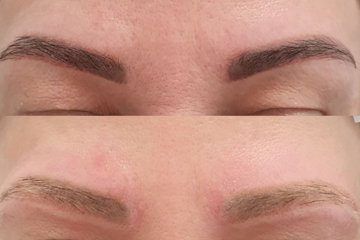 Удаление татуажа PicoSure 01