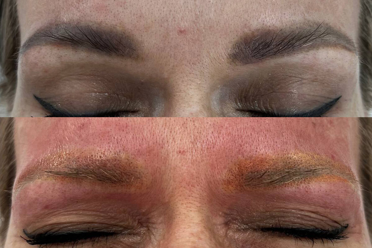 Удаление татуажа PicoSure 01