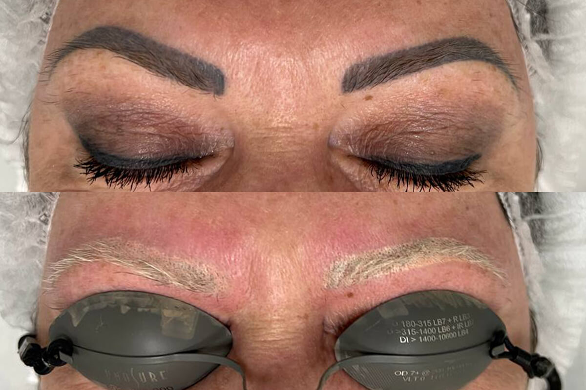 Удаление татуажа PicoSure 01