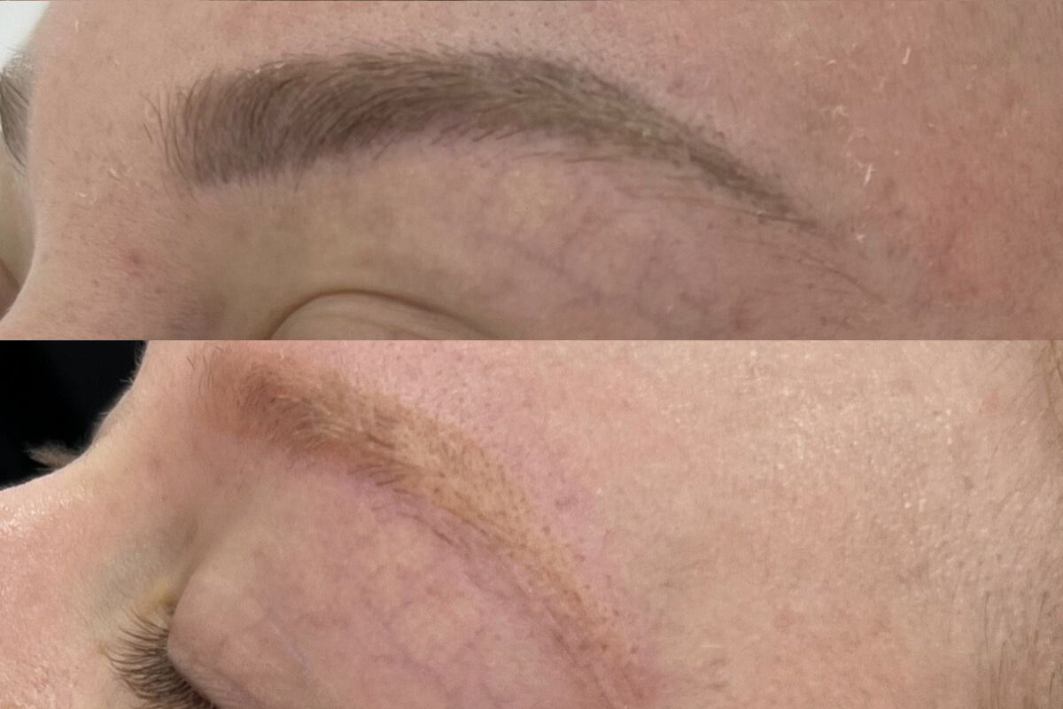 Удаление татуажа PicoSure 01