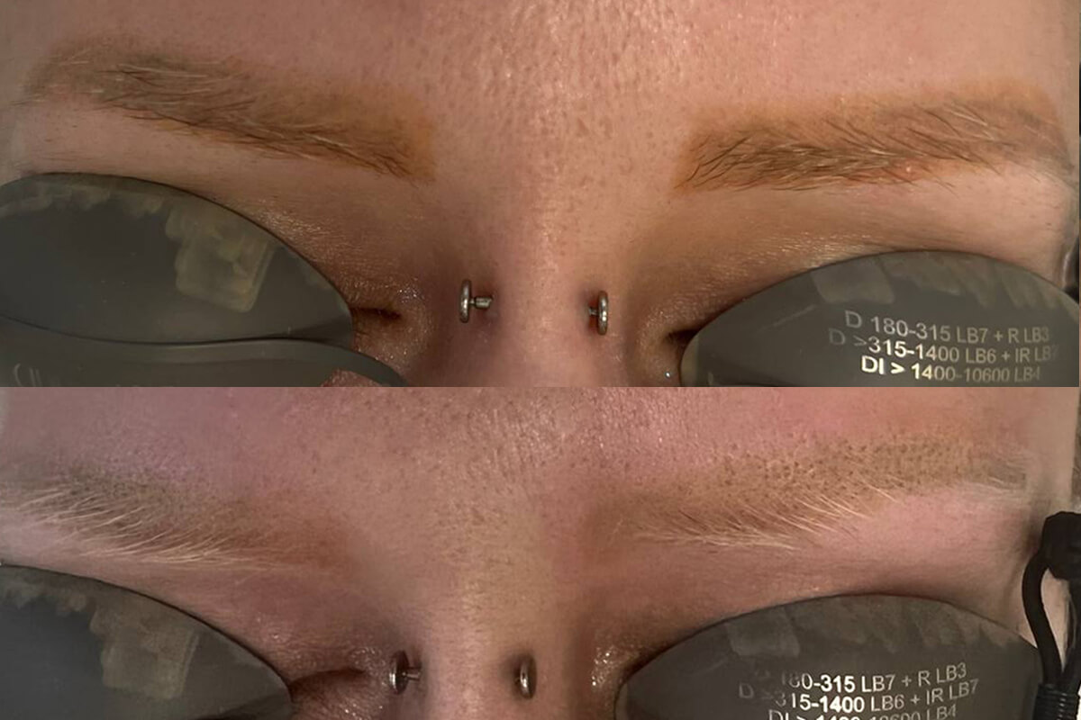 Удаление татуажа PicoSure 01