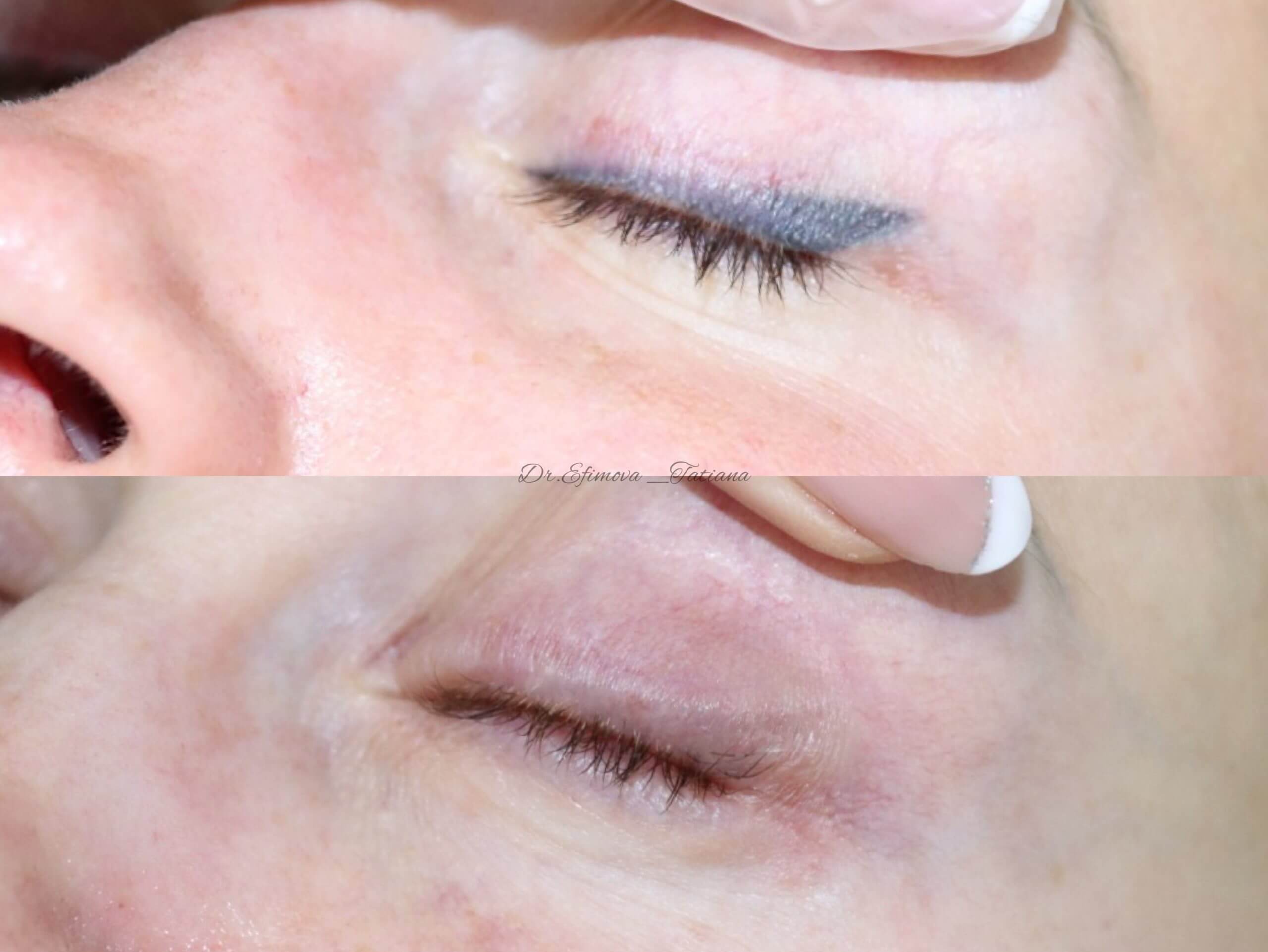 Удаление татуажа PicoSure 01