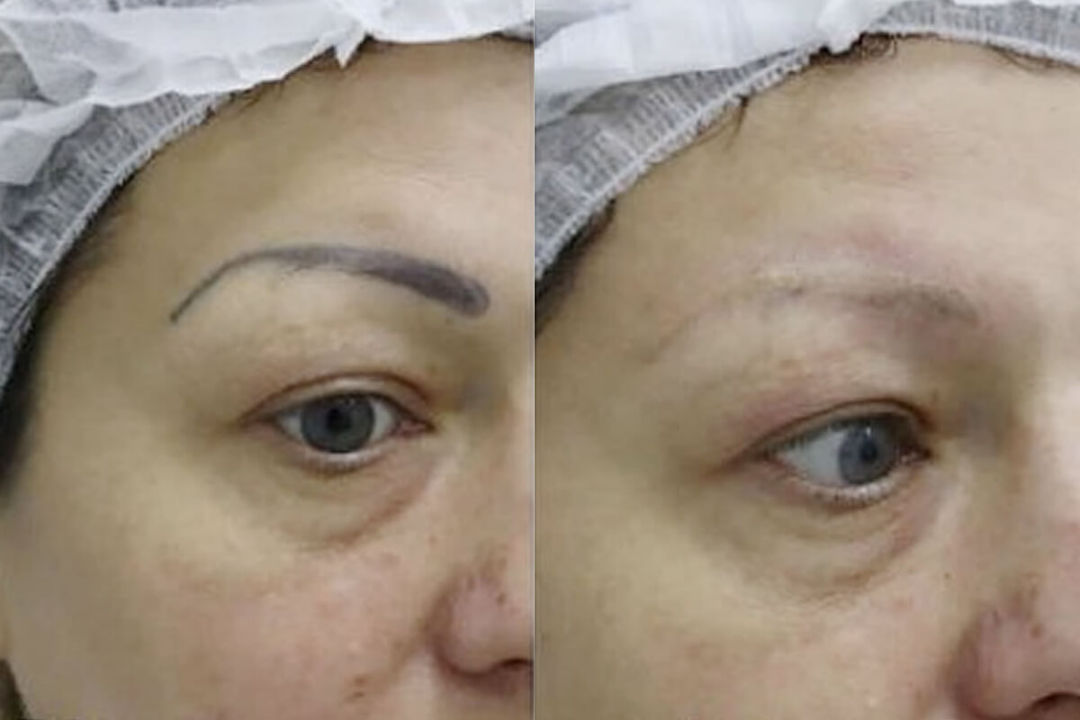 Удаление татуажа PicoSure 01