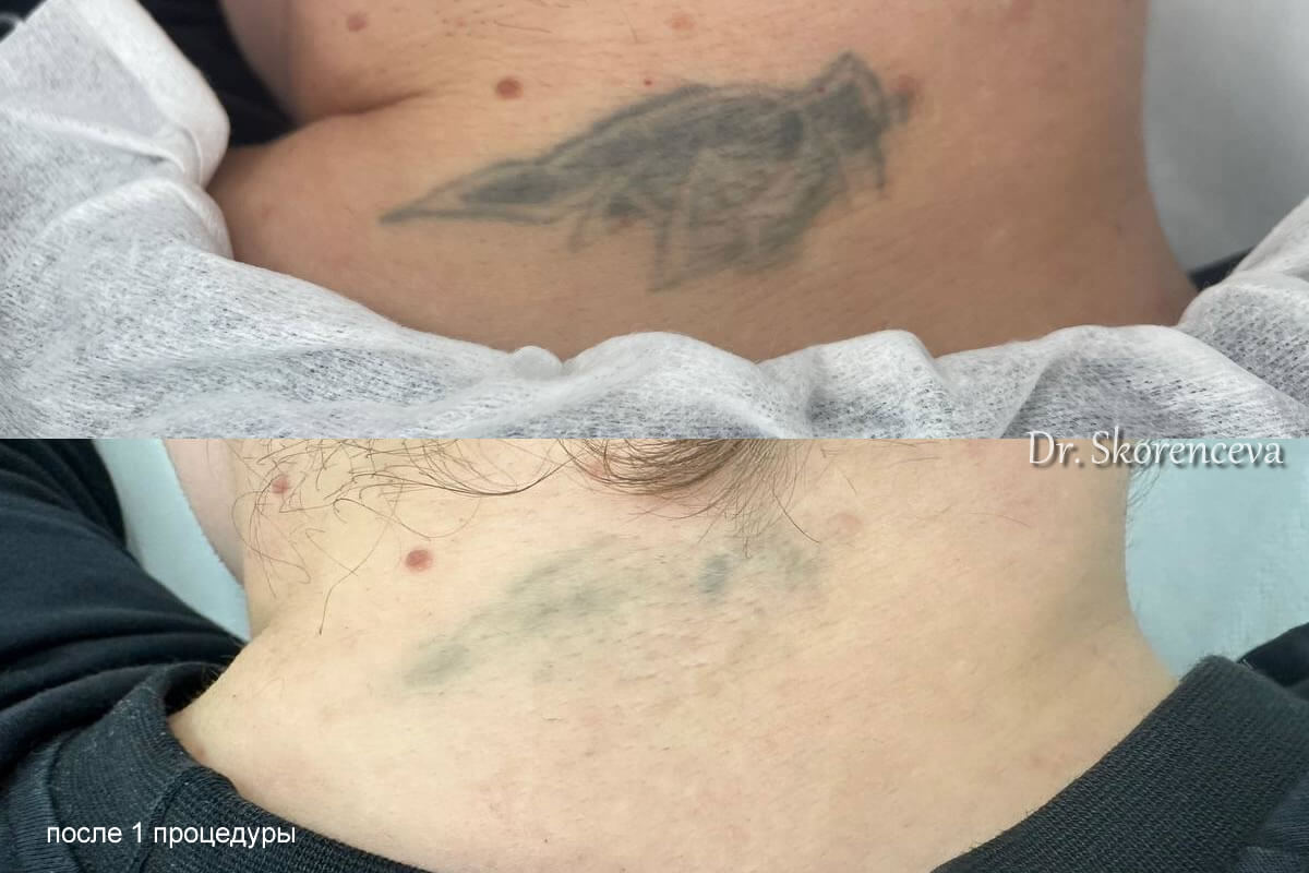 Удаление татуировок PicoSure 01