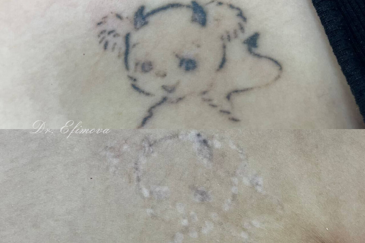Удаление татуировок PicoSure 01