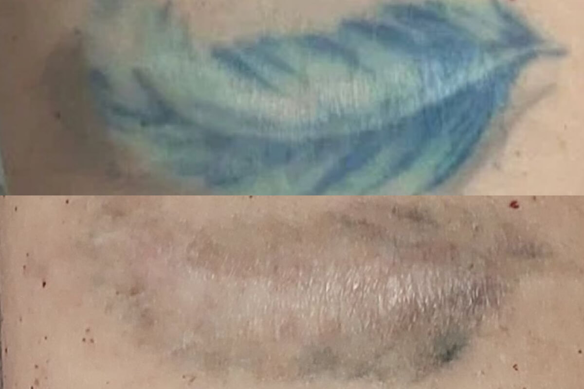 Удаление татуировок PicoSure 01