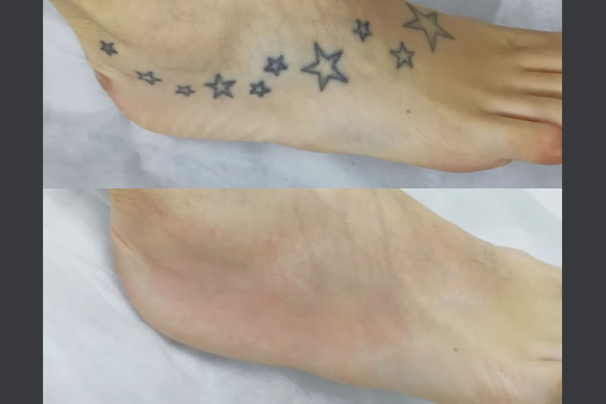 Удаление татуировок PicoSure 01