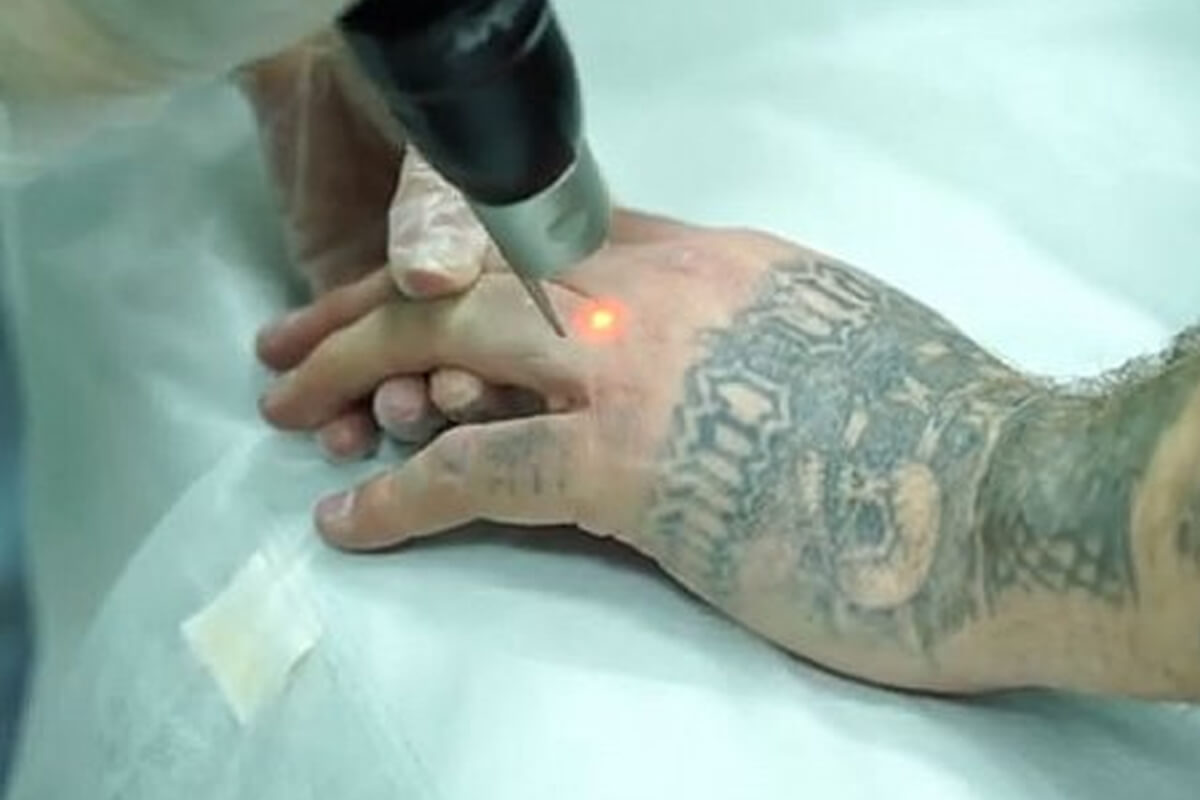 Удаление татуировок PicoSure 01