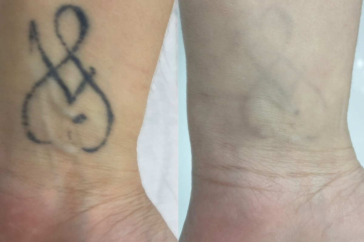 Удаление татуировок PicoSure 01