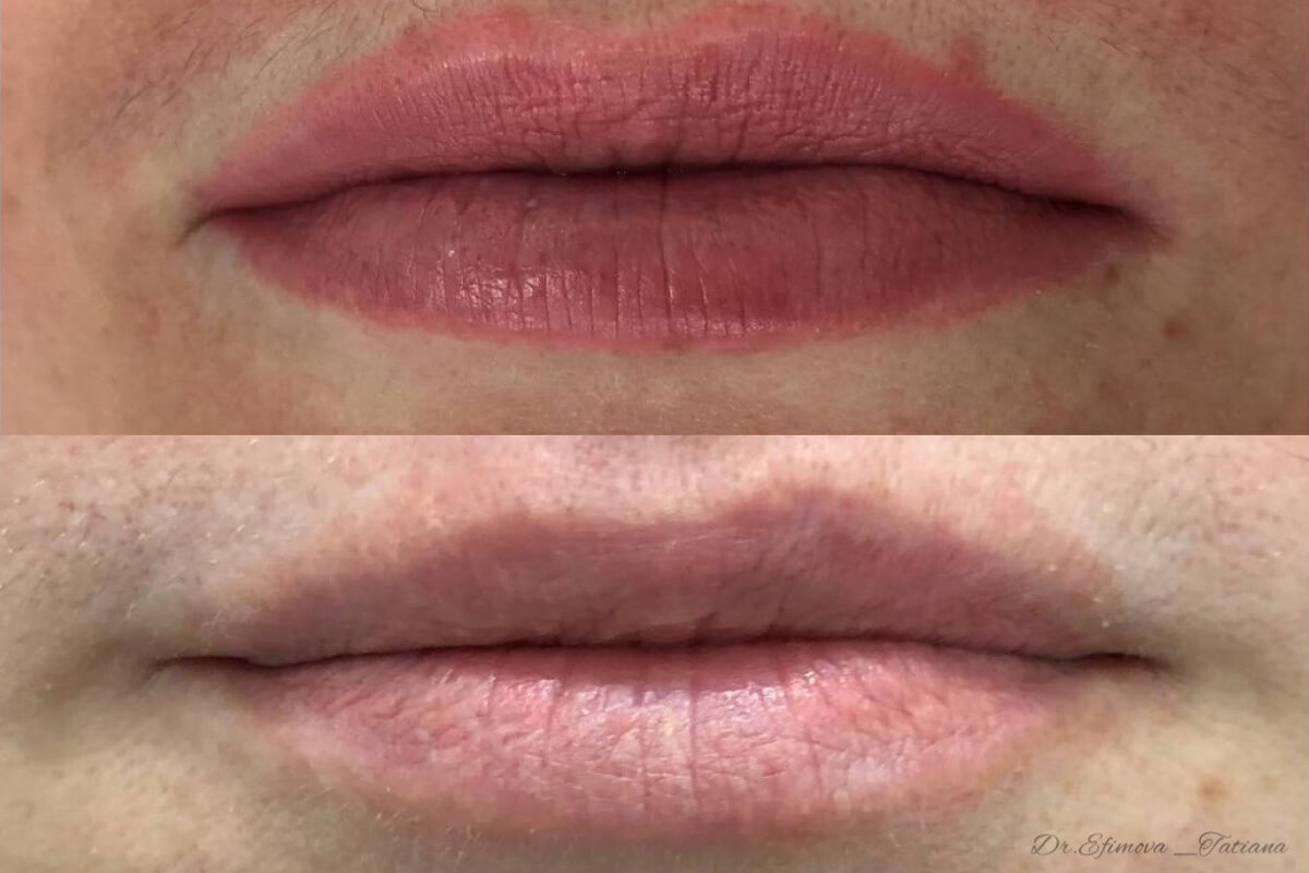 Удаление татуажа PicoSure 01