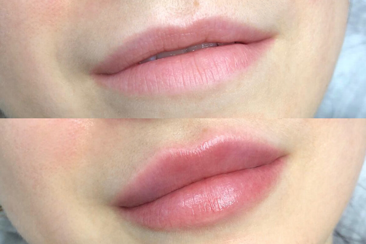 Увеличение губ 01