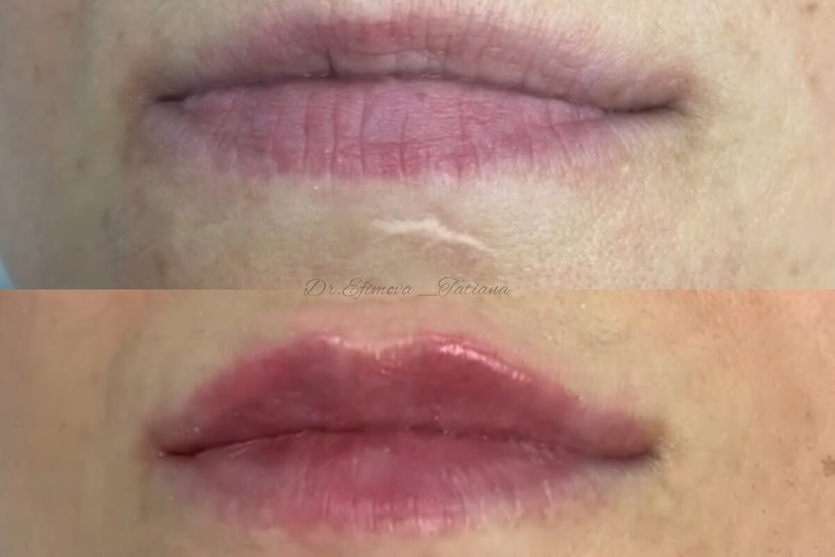 Увеличение губ 01