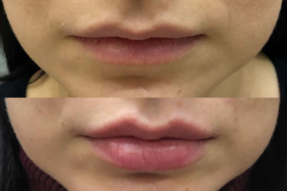 Увеличение губ 01