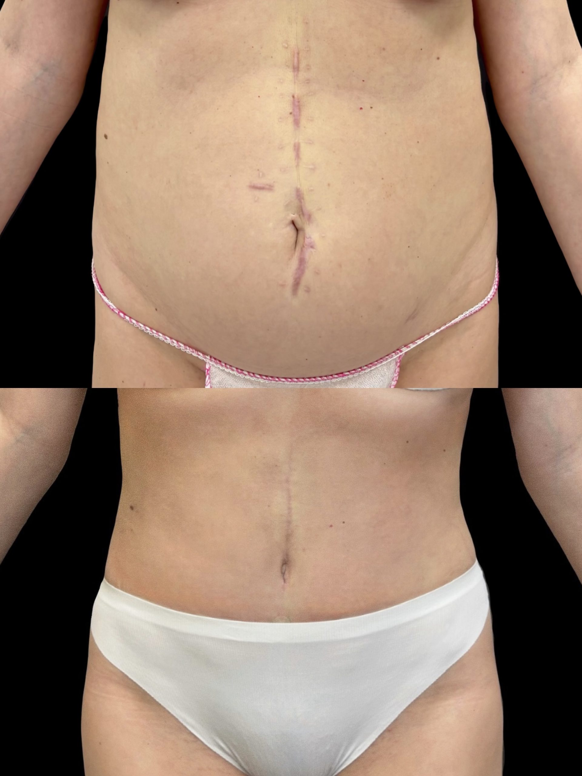 Абдоминопластика с переносом пупка 01