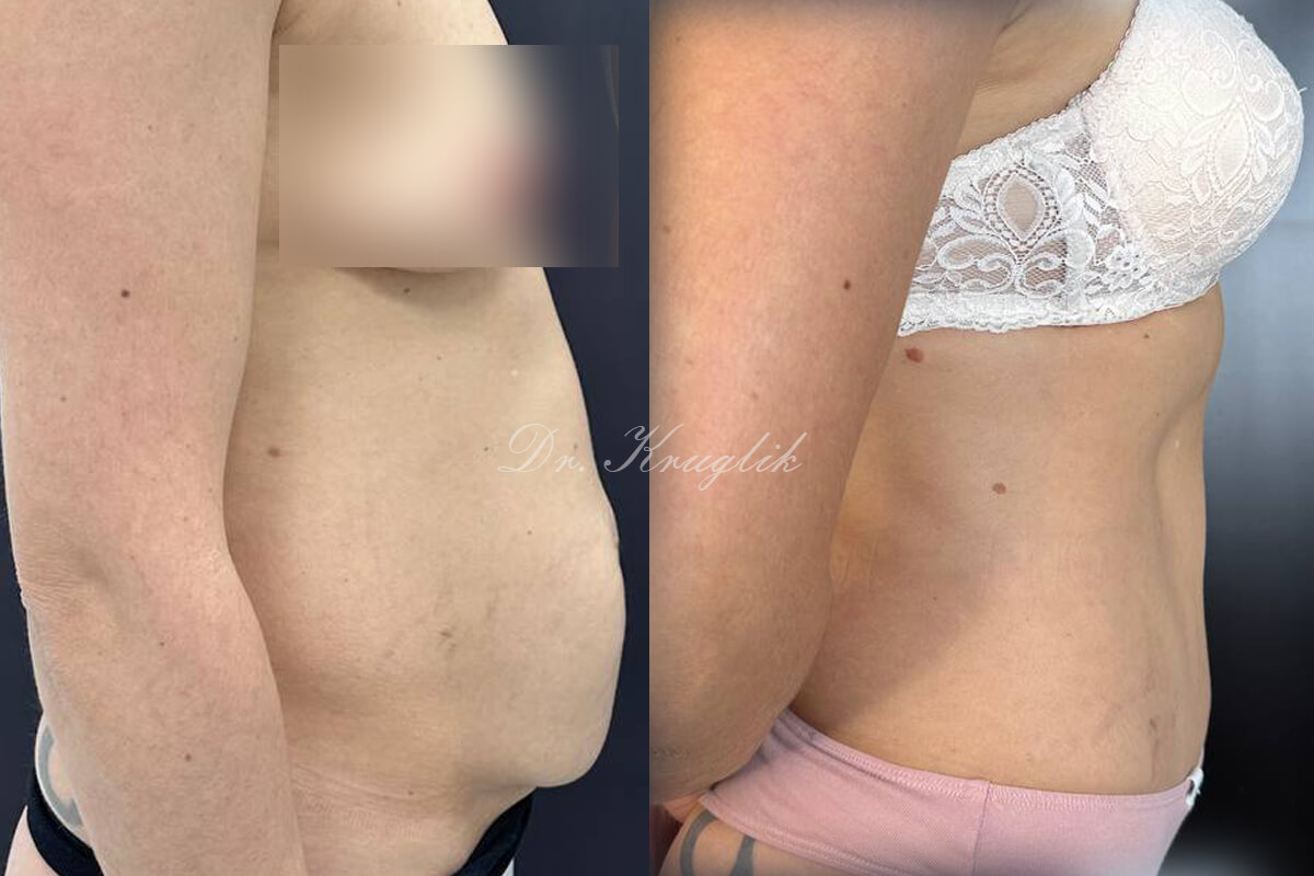 Абдоминопластика с переносом пупка 01